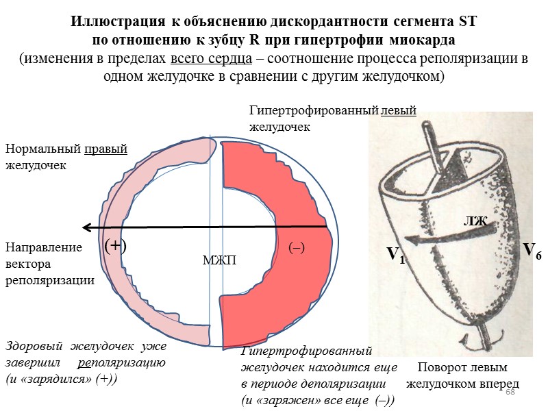68 (+) (–) Направление вектора реполяризации Нормальный правый желудочек Гипертрофированный левый желудочек 68 (+) (–) Направление вектора реполяризации Нормальный правый желудочек Гипертрофированный левый желудочек